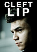 Cleft Lip
